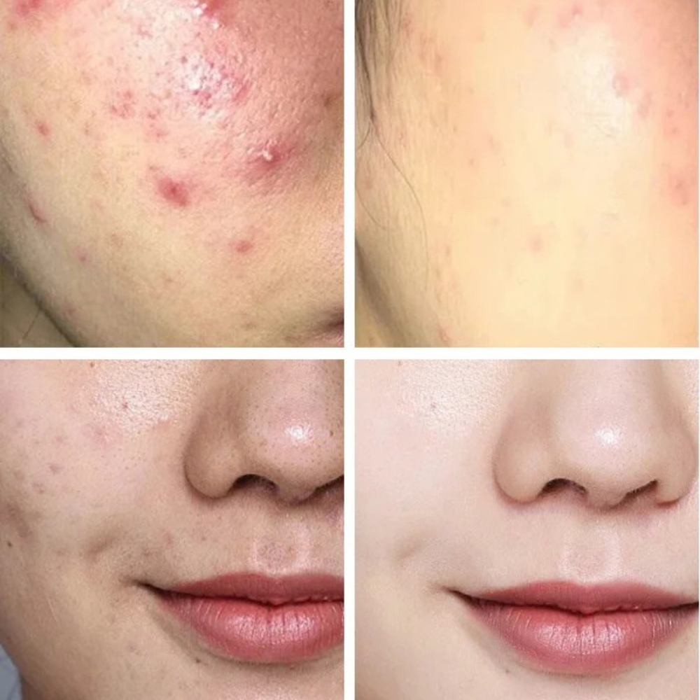 Crème Anti-Imperfections Acide Salicylique - JOUVENCE COREENNE