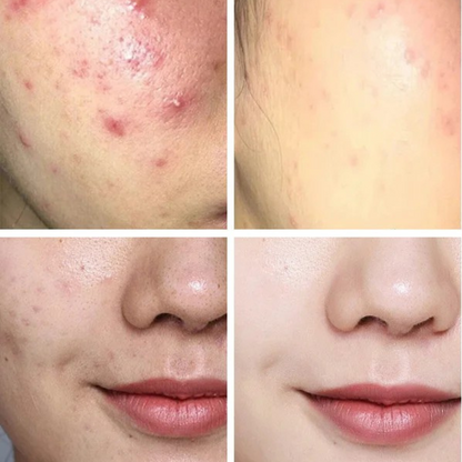 Crème Anti-Imperfections Acide Salicylique - JOUVENCE COREENNE